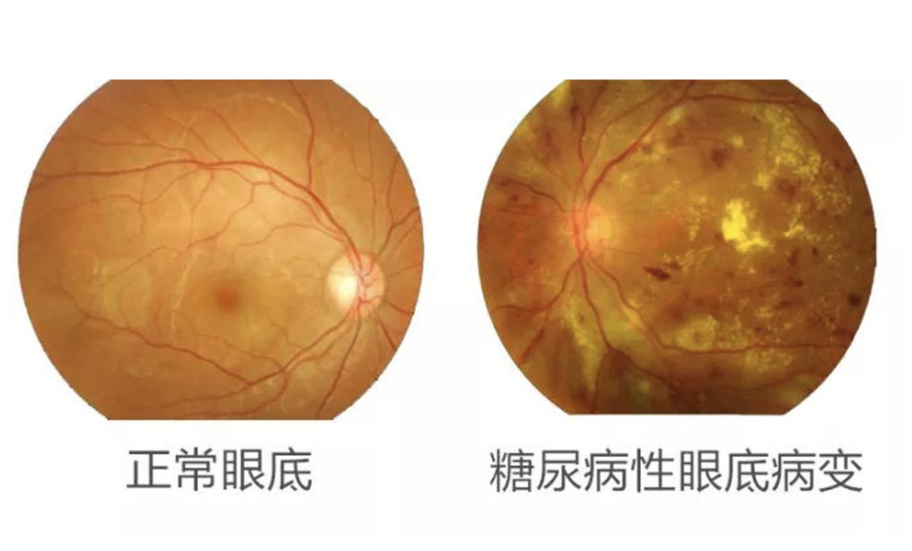 出现这个症状,可能是失明前兆