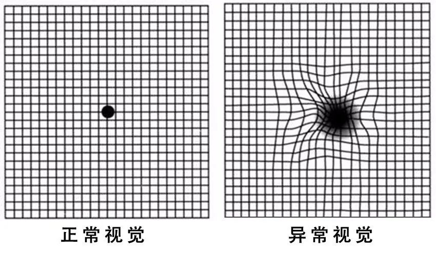 出现这个症状,可能是失明前兆