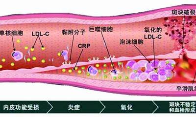 血管里脂质斑块形成过程 脂肪酸大战