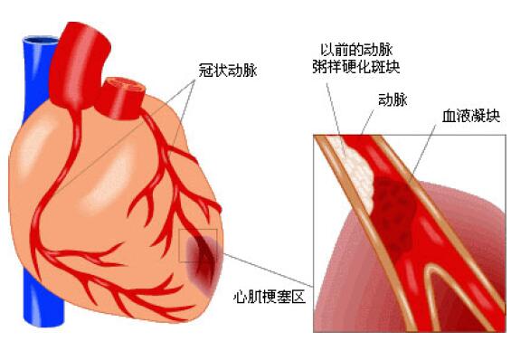 冠状动脉粥样硬化 脂肪酸大战