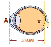 近视的“前世今生” 家有“近视娃”一定要看!