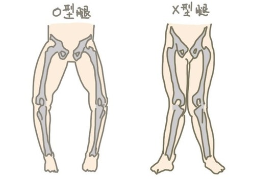 O型腿是哪些原因导致的