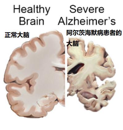 两颗大脑(图片来源:NIH)-responsive 阿尔茨海默病的迷思